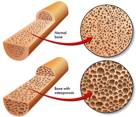 Bone-Mineral-Density-Osteoporosis.jpg