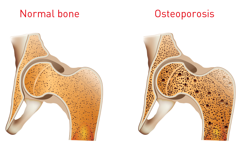 Osteoporosis.png
